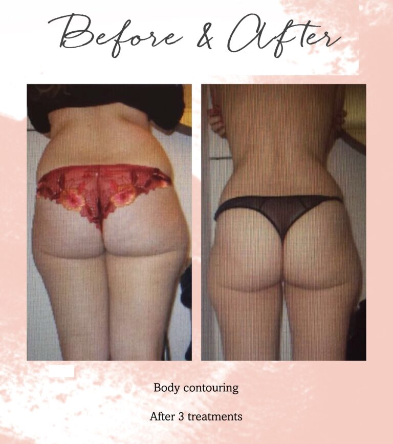 Body-contouring3