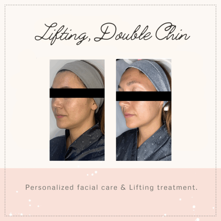 before-and-after-_doublechinantiaging-1.png
