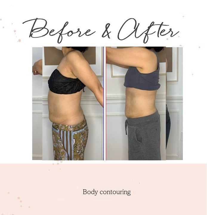 body-contouring2-2.jpg
