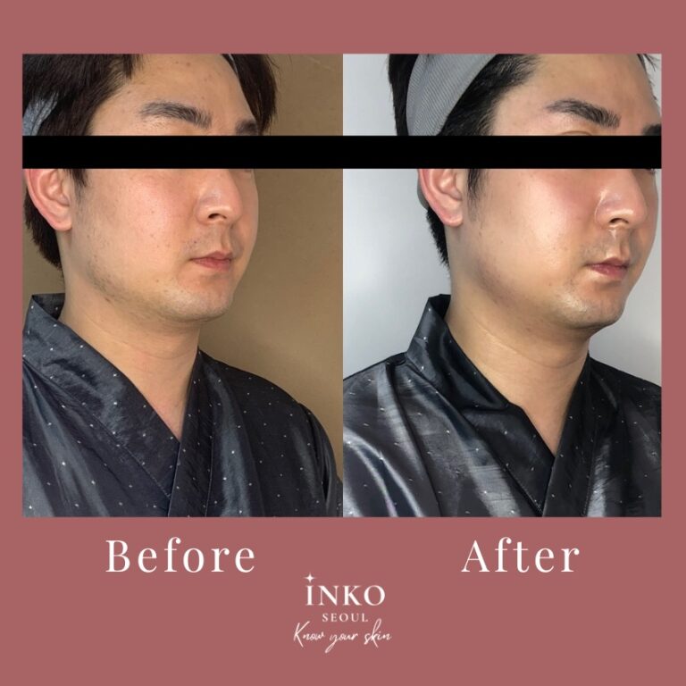 before-after1