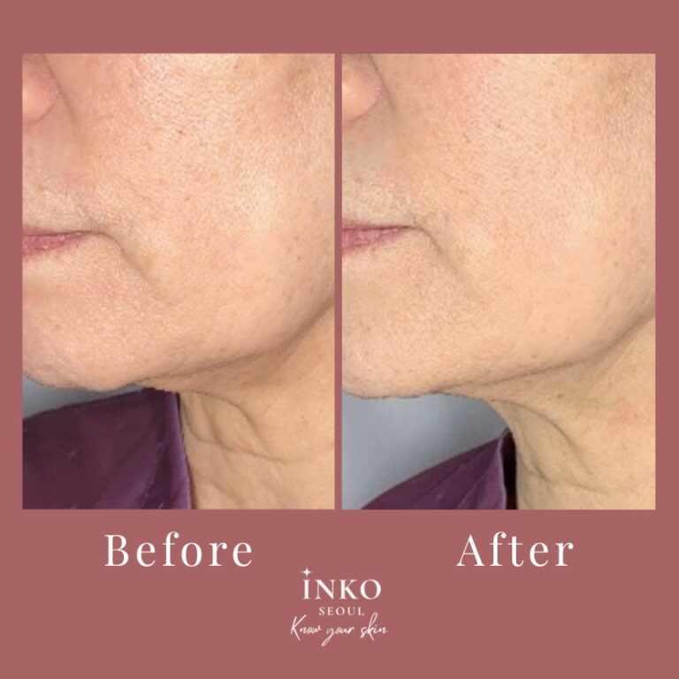before-after2