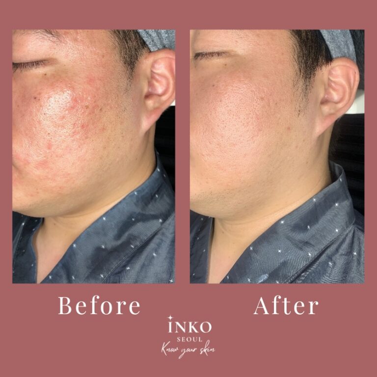 before-after3