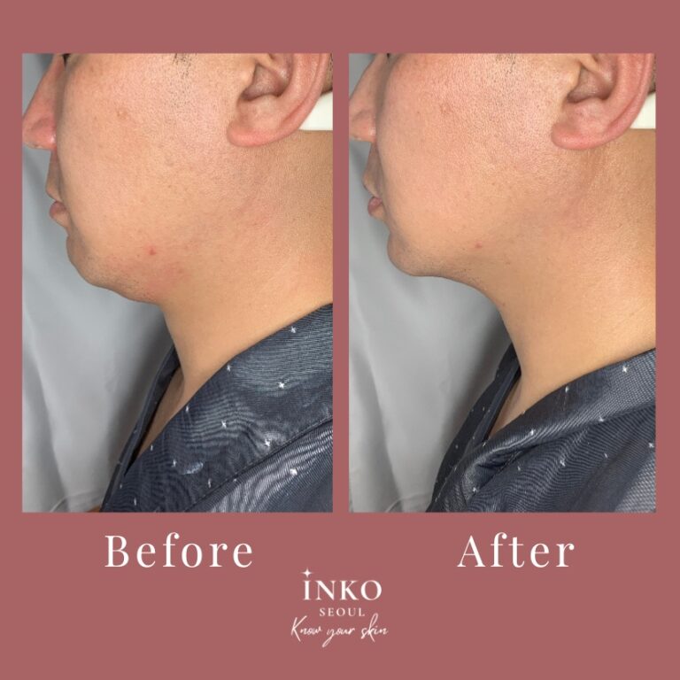 before-after4