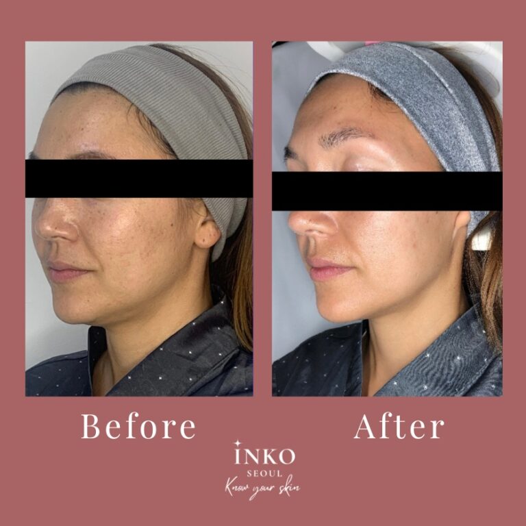 before-after5