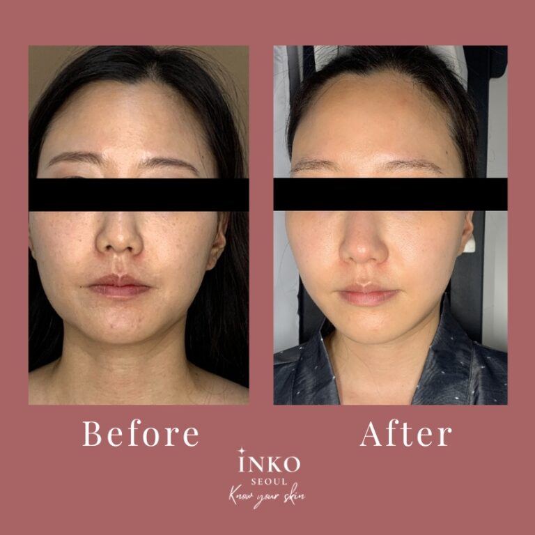before-after6