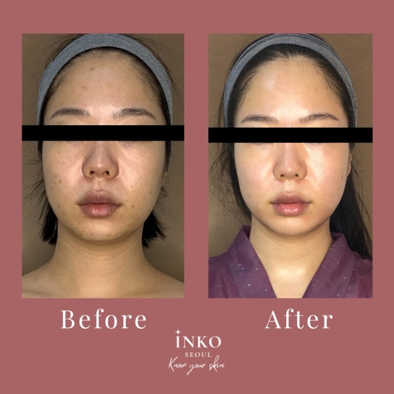 before-after7