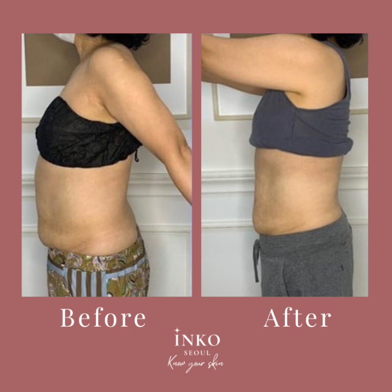 before and after10