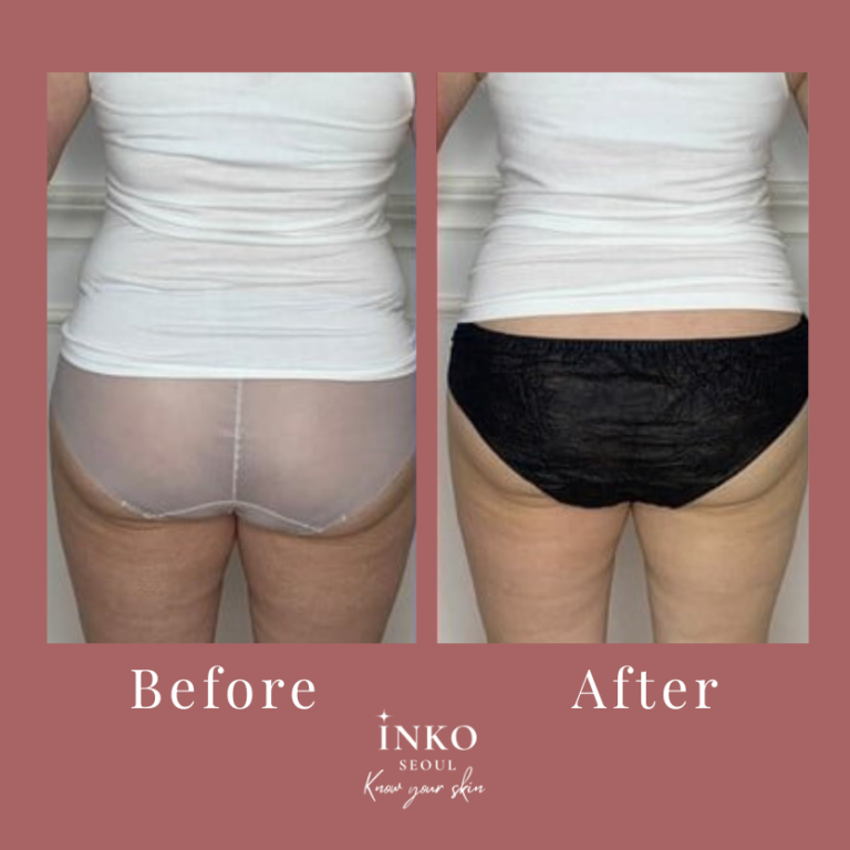 before and after11
